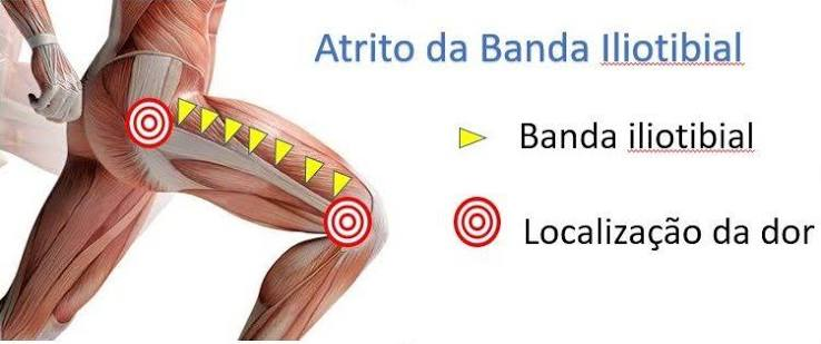 Síndrome da Banda Iliotibial (SBIT)